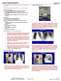 What is the meaning of apico abbreviation? Chest Radiography Lung Anatomical Terms Of Location