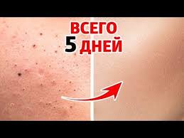 как избавиться от прыщей в домашних условиях за один день Kak Izbavitsya Ot Chernyh Tochek 1 Minuta V Den Youtube V 2020 G Lico Trenirovka Na 30 Dnej Chistoe Lico