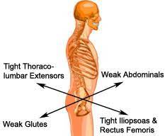 Lower Crossed Syndrome Physical Therapy Cyberpt