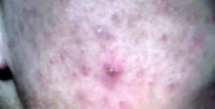 Cystic acne is not only painful it can cause permanent scarring and even embarrassment for those cystic acne occurs when an infection goes deeper into the skin, usually showing up in the dermis layer. Severe Acne Linked To Endometriosis 2 Minute Medicine