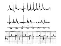Cardiac Arrhythmias And Sudden Death