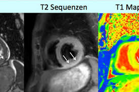 Der arzt wird sie zur diagnose einer herzmuskelentzündung (myokarditis) zunächst nach symptomen wie kurzatmigkeit oder schwellung der beine fragen. Kardiale Mrt Goldstandard Bei Fokalen Narben Management Krankenhaus