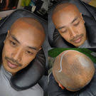 Hairloss Solution