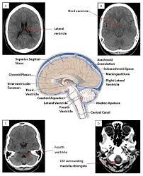 How To Interpret An Unenhanced Ct Brain Scan Part 1 Basic Principles Of Computed Tomography And Relevant Neuroanatomy