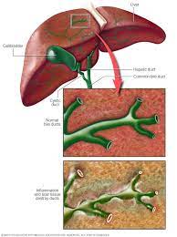 Biliary drainage is performed with a tube or catheter (called a biliary drain, biliary stent or biliary catheter) by a surgeon or, commonly, an interventional radiologist.3 it can be used to relieve a. Primary Biliary Cholangitis Symptoms And Causes Mayo Clinic