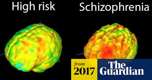 It is a disease that makes it difficult for a person to tell the difference between real and unreal experiences, to think logically, to have normal emotional responses to others, and to behave normally in social situations. Radical New Approach To Schizophrenia Treatment Begins Trial Schizophrenia The Guardian