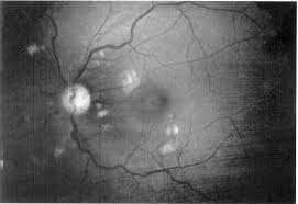 Image result for HIV Retinitis