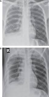 Pleural eﬀusions can loculate as a result of adhesions. Pleural Effusion Diagnosis Treatment And Management Abstract Europe Pmc