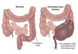 Signs and symptoms of colon cancer include: Hirschsprung S Disease Boston Children S Hospital