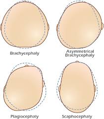 Image result for Positional Head Deformity