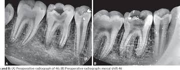 We did not find results for: Radix Entomolaris With Middle Mesial Canal A Rare Case Semantic Scholar