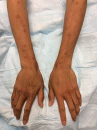 Image result for Diffuse Hyperpigmentation