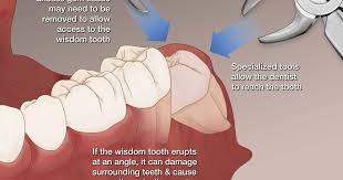 I have no insurance and i need to get my wisdom teeth pulled im in pain what can i do? answered by dr. Wisdom Teeth Removal Scottsdale Az Phoenix Az Dental Works