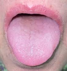 Image result for brown tongue symptoms