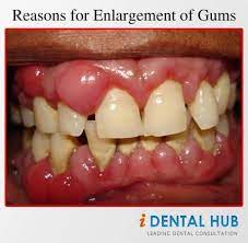 Increase In Size Of Gums Is Known As Gingivitis Initially Term Gingival Hypertrophy Or Gingival Hyperplasia Was Swollen Gum Gum Treatment Gum Disease Remedies