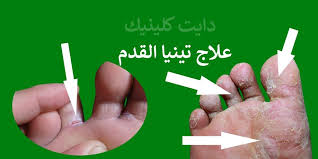 علاج تينيا القدم وبين الأصابع بالأدوية والطب البديل بالأعشاب Icing Food Desserts