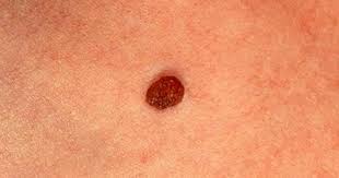 I often tell my patients if they have a spot that looks like a pimple or a sore that hasn't healed, i want them to come in, mcneil says. Skin Cancer Or Mole How To Tell Cbs News