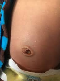 The cord can't fall off too early. Umbilical Cord Fell Off At 5 Days Old Babycenter