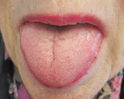 Image result for Fissured tongue
