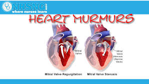 The mechanical obstruction leads to increases in pressure. Heart Murmurs Aortic Mitral Stenosis Regurgitation How To Identify Heart Murmur Heart Symptoms Mitral Valve