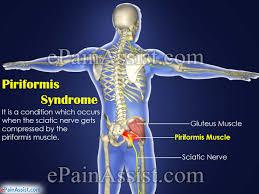 How long does it take to recover from piriformis syndrome? Piriformis Syndrome Treatment Pt Exercise Prevention