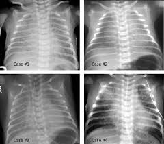Soft decrease in transparency with an aerobronchogram, which overlaps the heart (= always a sign of an alveolar lung reaction. Respiratory Distress In The Newborn American Academy Of Pediatrics