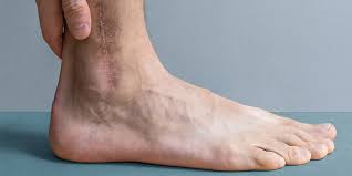 Scars can be extremely difficult to remove. Scars On Legs Removal Treatment And Prevention Methods