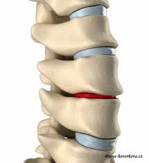 Image result for vyhřezlá ploténka