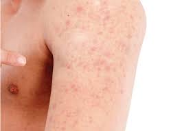 Image result for Sebaceous Hyperplasia