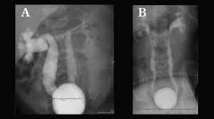 The Vur Uti Connection Multiple Factors At Play Children S Hospital Of Philadelphia