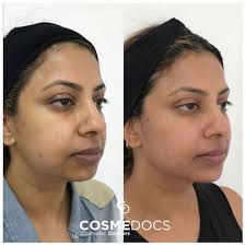 As with any injectable treatment, it is worth having consultations with a few doctors to find the person you feel most comfortable with and who has an aesthetic most similar to your goals. Chin Filler Before And After To Improve Face Profile Jaw And Chin Filler