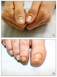 Image result for Beau lines feet