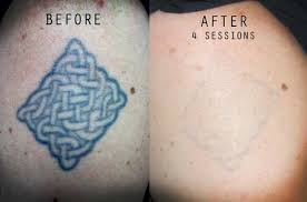 Home tattoo removal worked with fading and lightening, but it was slow and didn't completely erase my tats. Tattoo A Big No In Defence And Aviation Dermaworld Skin Clinic