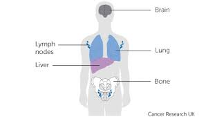 When cancer spreads to your bones, it can cause pain and make them weak enough to fracture. Where Cancer Can Spread Cancer Research Uk