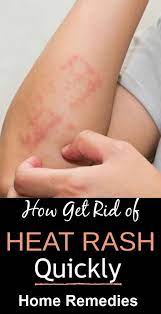 How To Get Rid Of Prickly Heat Heat Rash In 2021 Heat Rash Rash Treatment Heat Rash Remedy