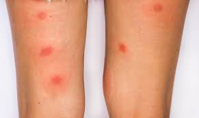 Maybe you would like to learn more about one of these? Piqures De Punaise De Lit A Quoi Ressemblent Ces Boutons Guidenuisibles Com