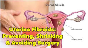 Pin On Fibroid Uterus Treatments