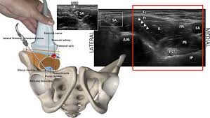 We did not find results for: Reply To Dr Roy Et Al Total Postoperative Analgesia For Hip Surgeries Peng Block With Lfcn Block Regional Anesthesia Pain Medicine