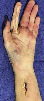 Flexor tendon injuries require surgical repair to restore active digit flexion. Zone 2 Flexor Tendon Repair Location And Risk Of Catching On The A2 Pulley Journal Of Hand Surgery