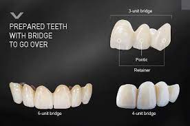 Most dentist offices will provide you with a cost quote depending on your. Dental Bridges Why Choose A Dental Bridge Over A Dental Implant