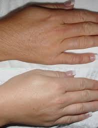 Shaving and using depilatory creams only remove the part of the hair that is above the skin, which does give the appearance of hairlessness but only for. Laser Hair Removal Benessere Clinic