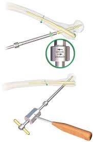 A succinct technique for the extraction of the proximal ...