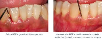Cost Of Periodontal Treatments Perio Peak