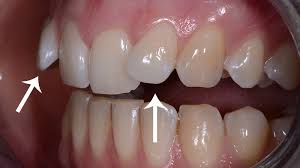 Tratamento Realinha Dentes Tortos E Girados Com Facetas E Laminas