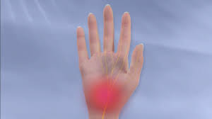 Carpal Tunnel Syndrome Uw Orthopaedics And Sports Medicine Seattle