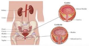 This Natural Antibiotic Treats Every Bladder Infection Nursing Diagnosis Urinary Tract Infection Urinary Tract