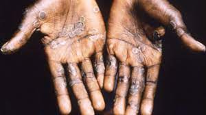 Learn the risks, symptoms and how to protect yourself when travelling or working in africa. Hsumnkdaic Tem