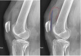 Image result for Knee Bulge Sign