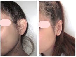 Trois types d'anomalie peuvent coexister : Otoplastie Chirurgie Des Oreilles Decollees Indications Techniques Remboursement Suites Et Cout Doctissimo