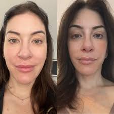 Hi everyone how long after treatment do you have to stay out of the sun ? I  e been told 2weeks then I've been told 2 months ? I guess everyone's skin